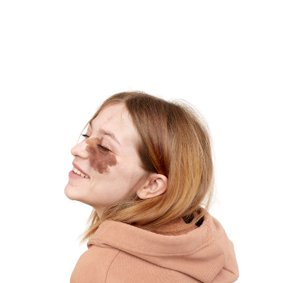 Doğum Lekesi Nedir? Doğum Lekesi Türleri Nelerdir?