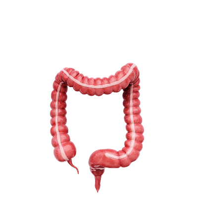 KALIN BARSAK (KOLON) KANSERİ