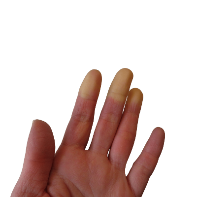 Raynaud Sendromu Nedir? Tedavisi Nasıl Yapılır?