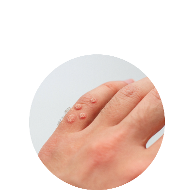 Cildimizde Siğil Neden Çıkar? Nasıl Geçer?