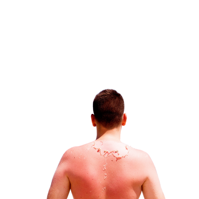 Güneş Yanığına Ne İyi Gelir?