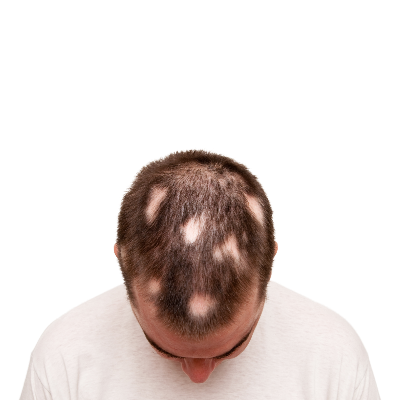 Saç Kıran (Alopesi Areata) Nedir? Nasıl Tedavi Edilir?